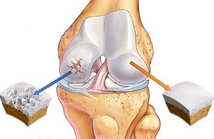 causes of arthrosis of the knee joint